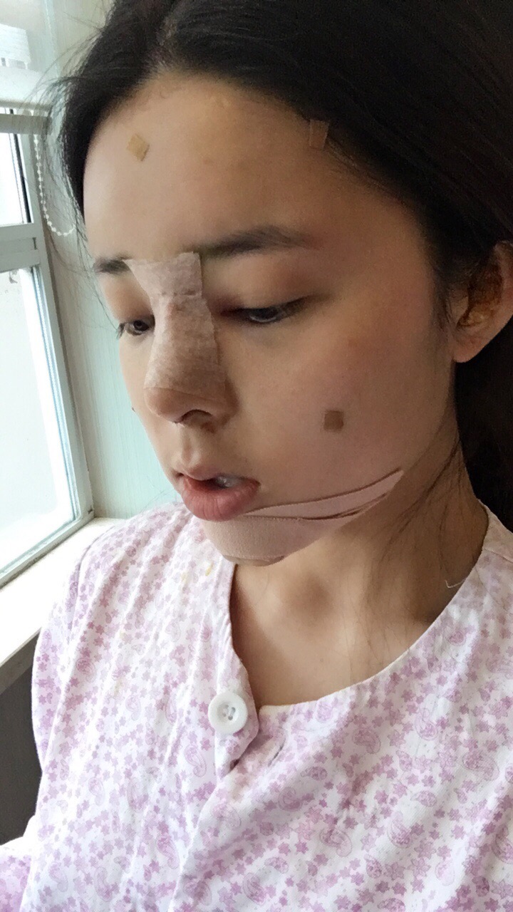 北京世濟周志強醫(yī)生鼻綜合案例