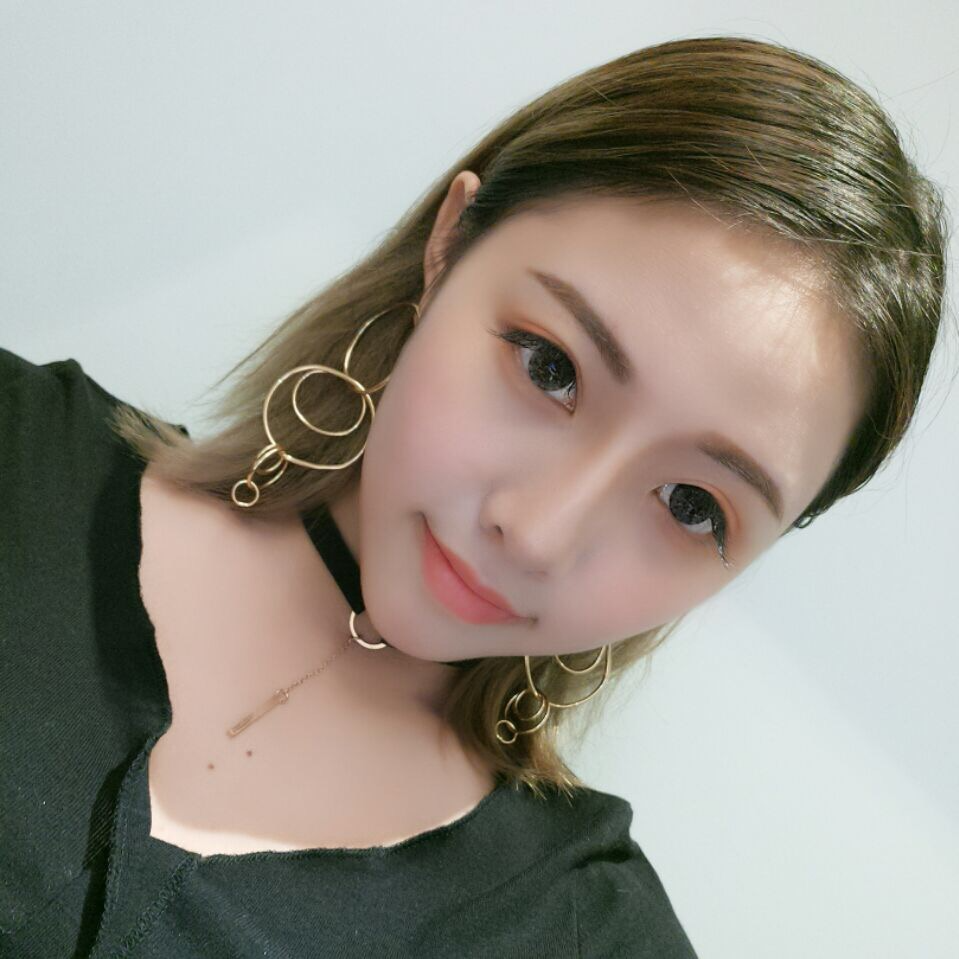 廣州中科美整形醫(yī)生徐長亮做切開雙眼皮怎么樣？附切開雙眼皮案例