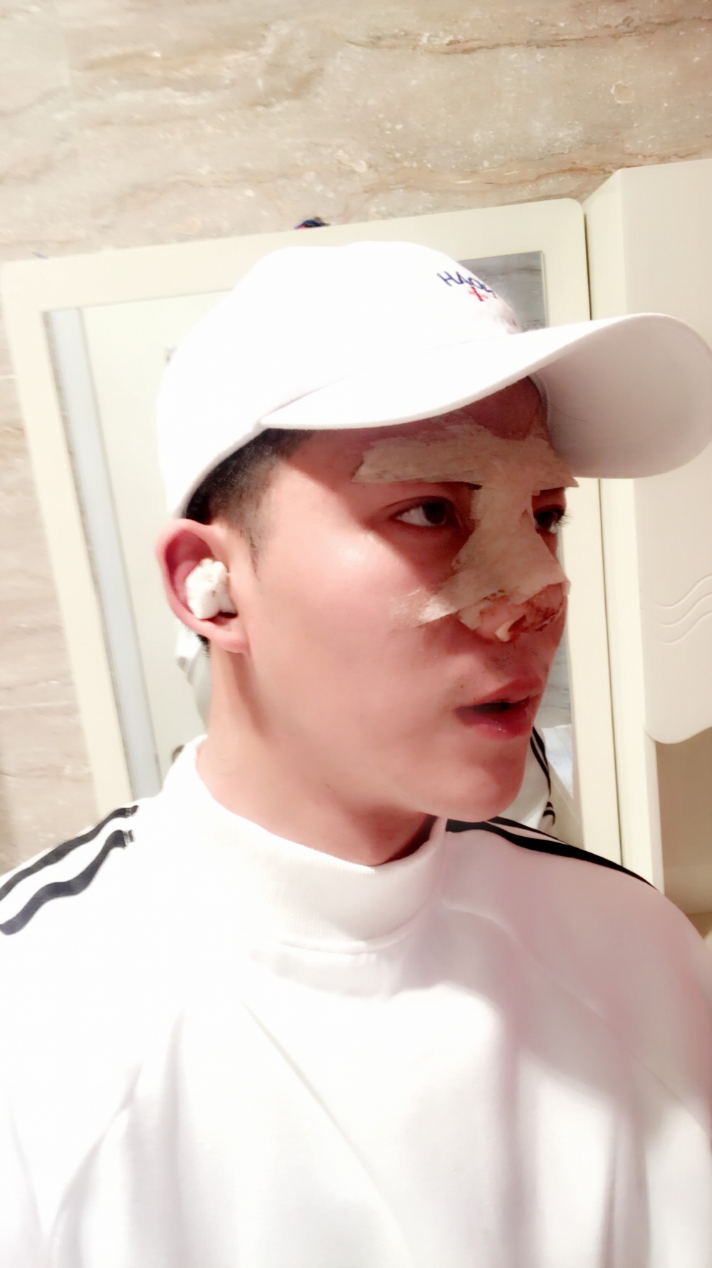 濟(jì)寧名美醫(yī)療整形醫(yī)生李唯少假體隆鼻+耳軟骨墊鼻尖真實(shí)案例效果對(duì)比圖