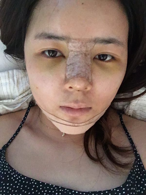 北京世濟周志強醫(yī)生鼻綜合案例