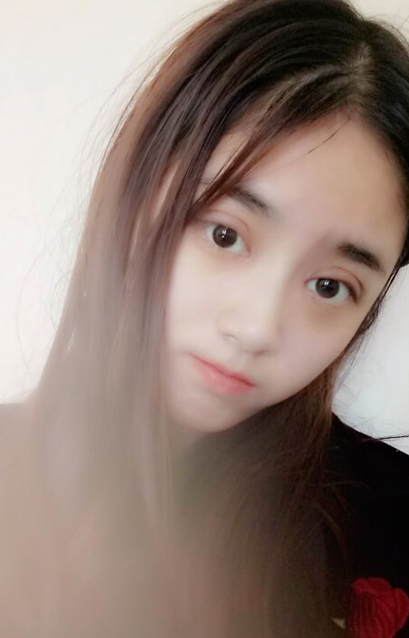 福州愛美爾整形黃林勝雙眼皮案例效果對比圖
