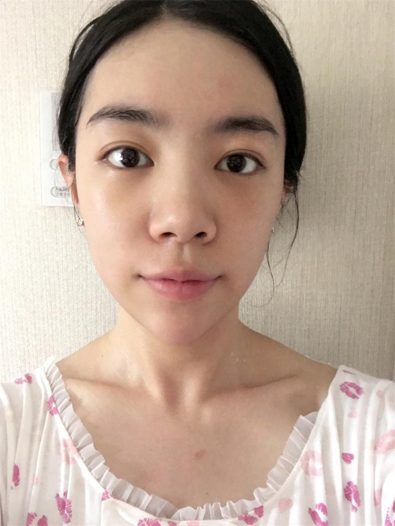 合肥壹加壹整形美容醫(yī)院做祛眼袋效果怎么樣？金大生祛眼袋案例分享