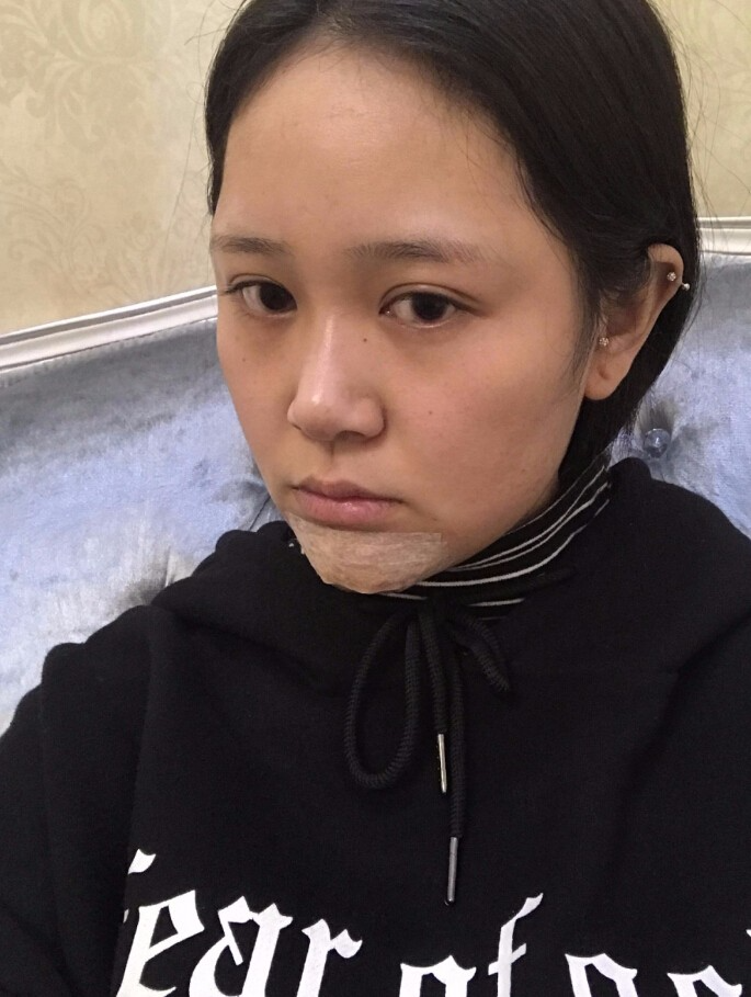 青島集美整形醫(yī)院做硅膠墊下巴怎么樣？趙煜楠醫(yī)生硅膠墊下巴真人案例