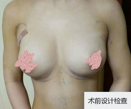 深圳博美整形醫(yī)生劉超做自體脂肪隆胸怎么樣？自體脂肪隆胸案例