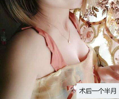 深圳博美整形醫(yī)生劉超做自體脂肪隆胸怎么樣？自體脂肪隆胸案例