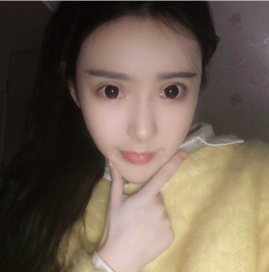 重慶柏漫醫(yī)療美容診所高紅艷醫(yī)生做面部吸脂怎么樣？面部吸脂案例分享