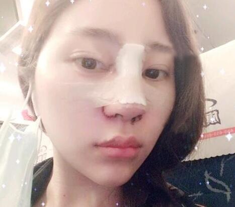 蘇州明基醫(yī)院醫(yī)療美容科做鼻綜合整形怎么樣？蘇州明基鼻綜合整形案例