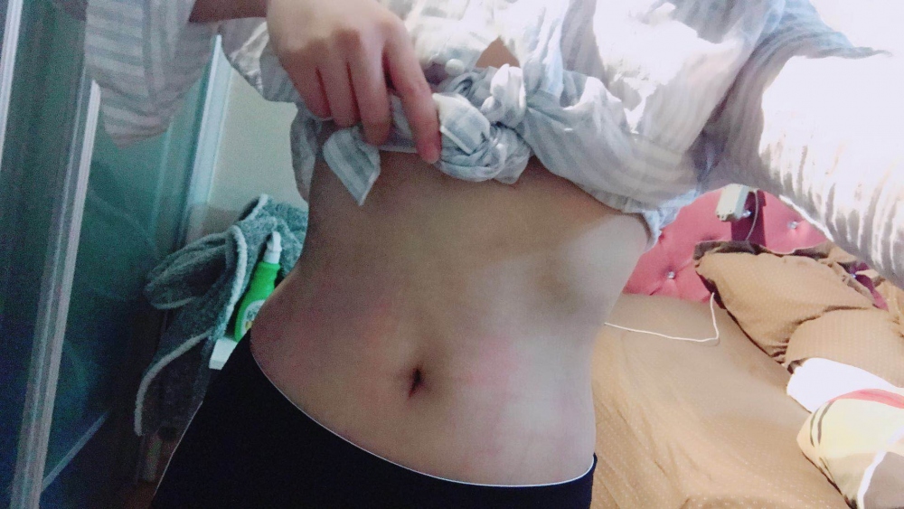 深圳晨曦整形醫(yī)院吉米斯做腰腹吸脂怎么樣？附吉米斯醫(yī)生腰腹吸脂案例