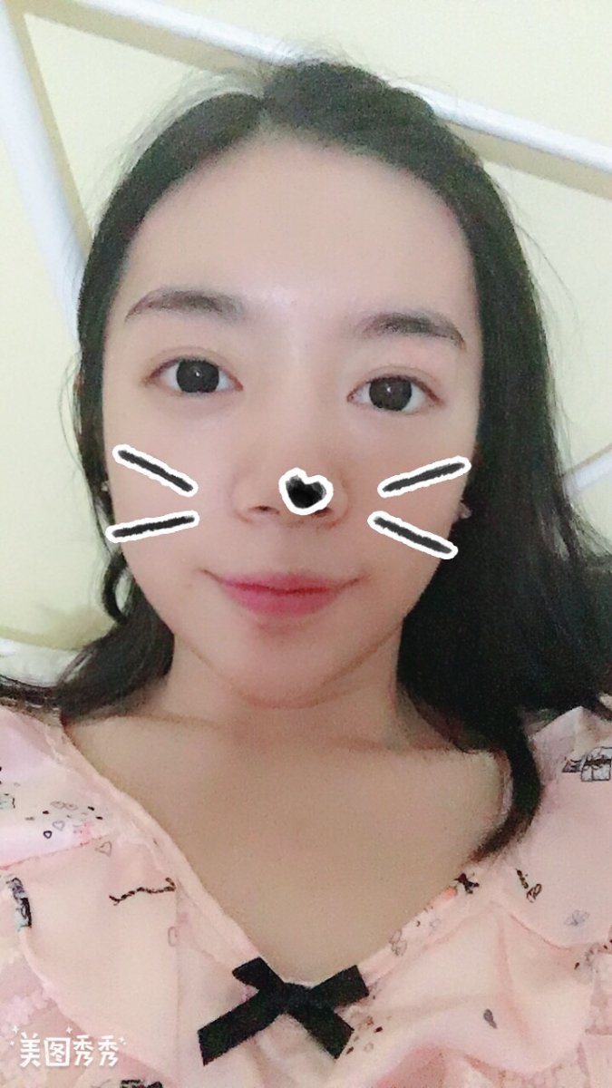 合肥壹加壹整形美容醫(yī)院做祛眼袋效果怎么樣？金大生祛眼袋案例分享