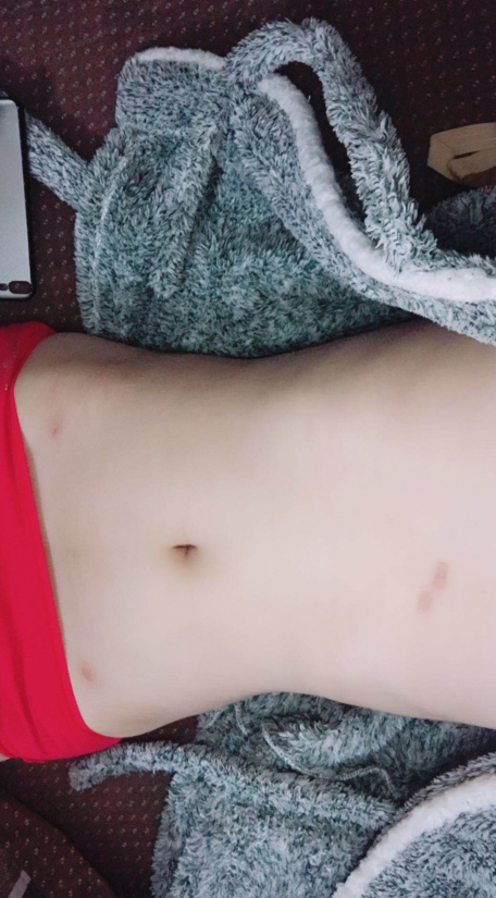 深圳晨曦整形醫(yī)院吉米斯做腰腹吸脂怎么樣？附吉米斯醫(yī)生腰腹吸脂案例