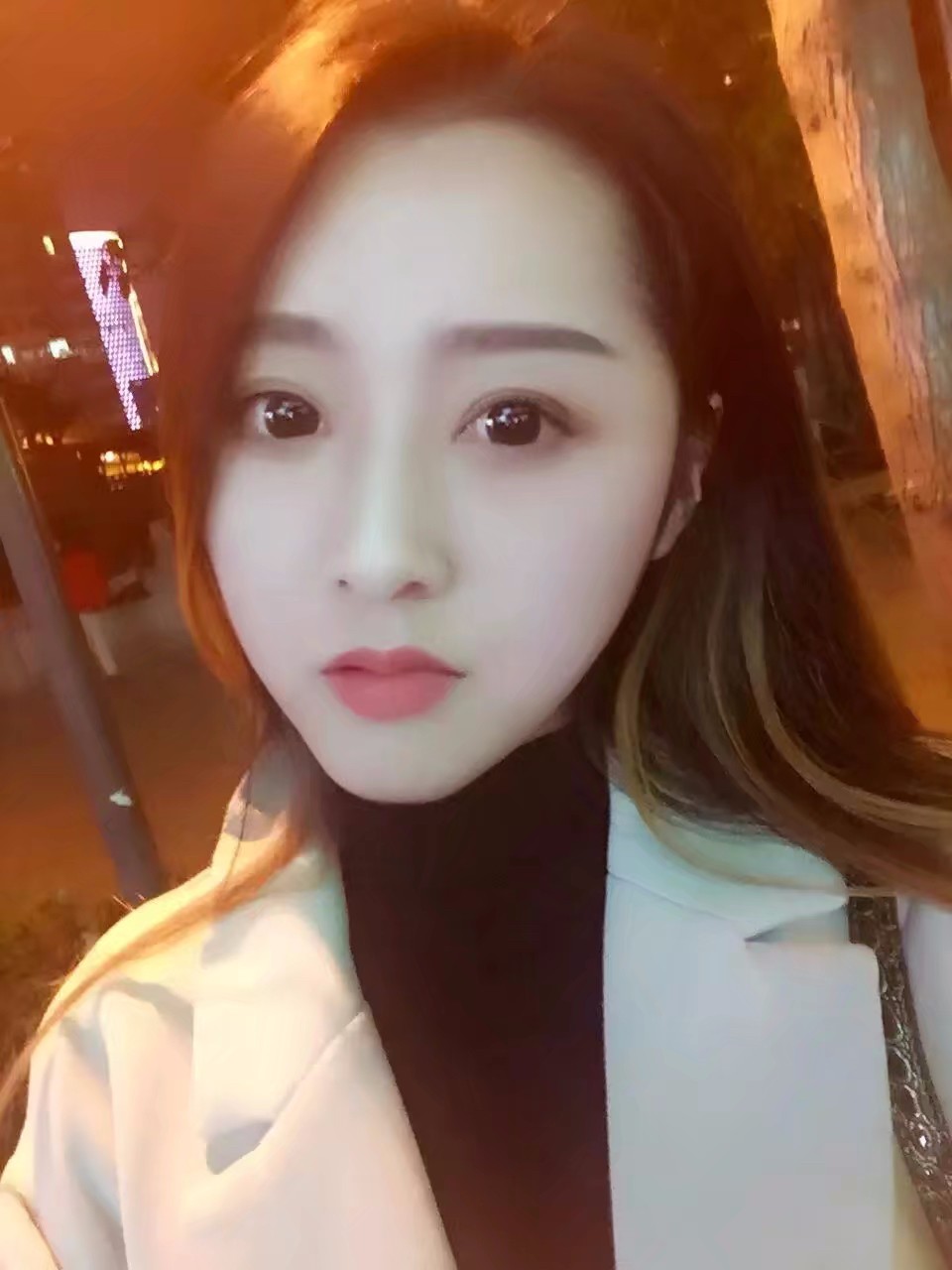 西安米蘭柏羽整形醫(yī)院李旭平做切開雙眼皮效果怎么樣？附案例