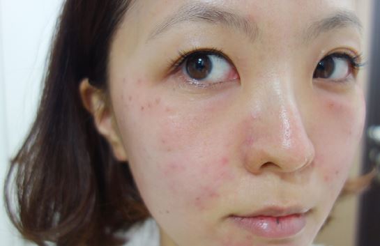 徐州時光洪揚醫(yī)療美容診所宮昔愿醫(yī)生做激光祛斑效果怎么樣？