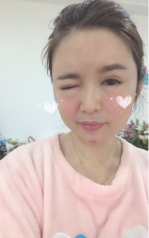 重慶聯(lián)合麗格美容醫(yī)院林麗蓉醫(yī)生做自體脂肪豐蘋果肌怎么樣？附案例