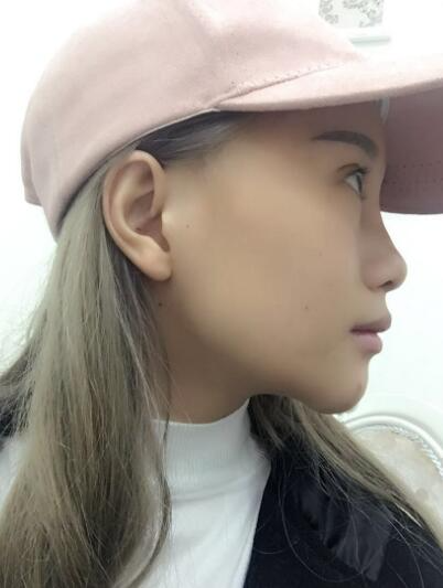 長春奧拉克美容醫(yī)院金相勛醫(yī)生做玻尿酸豐臥蠶怎么樣？附案例