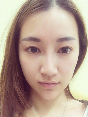 重慶五洲女子醫(yī)院整形美容中心做光子嫩膚怎么樣？淡明斌醫(yī)生光子嫩膚案例