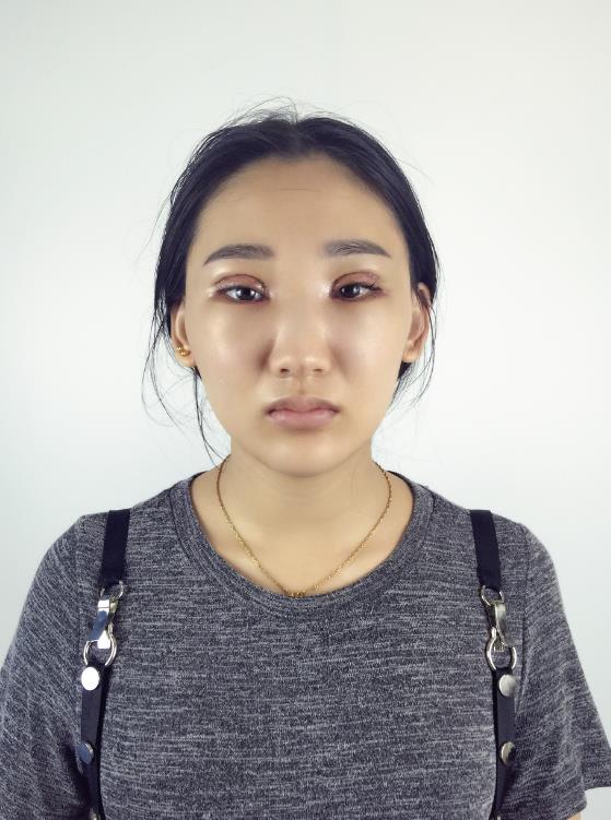武漢中翰整形外科醫(yī)院沈磊醫(yī)生做切開雙眼皮怎么樣？附沈磊切開雙眼皮案例