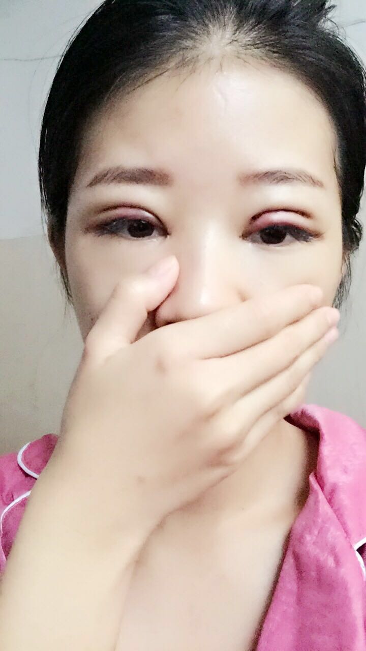 深圳晨曦醫(yī)療整形醫(yī)生吉米斯做切開雙眼皮怎么樣？吉米斯切開雙眼皮案例效果