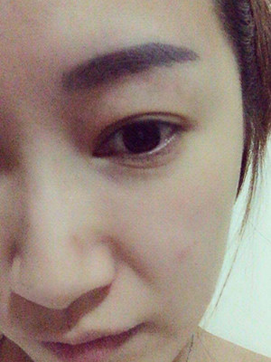 重慶五洲女子醫(yī)院整形美容中心做光子嫩膚怎么樣？淡明斌醫(yī)生光子嫩膚案例