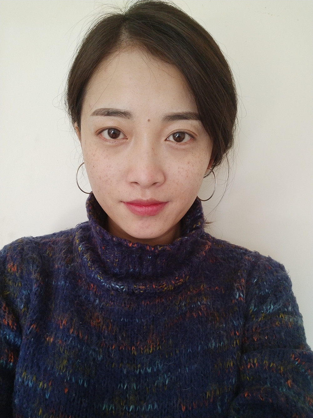 重慶當(dāng)代整形李敏旭醫(yī)生做皮秒激光祛斑效果怎么樣？附皮秒激光祛斑案例