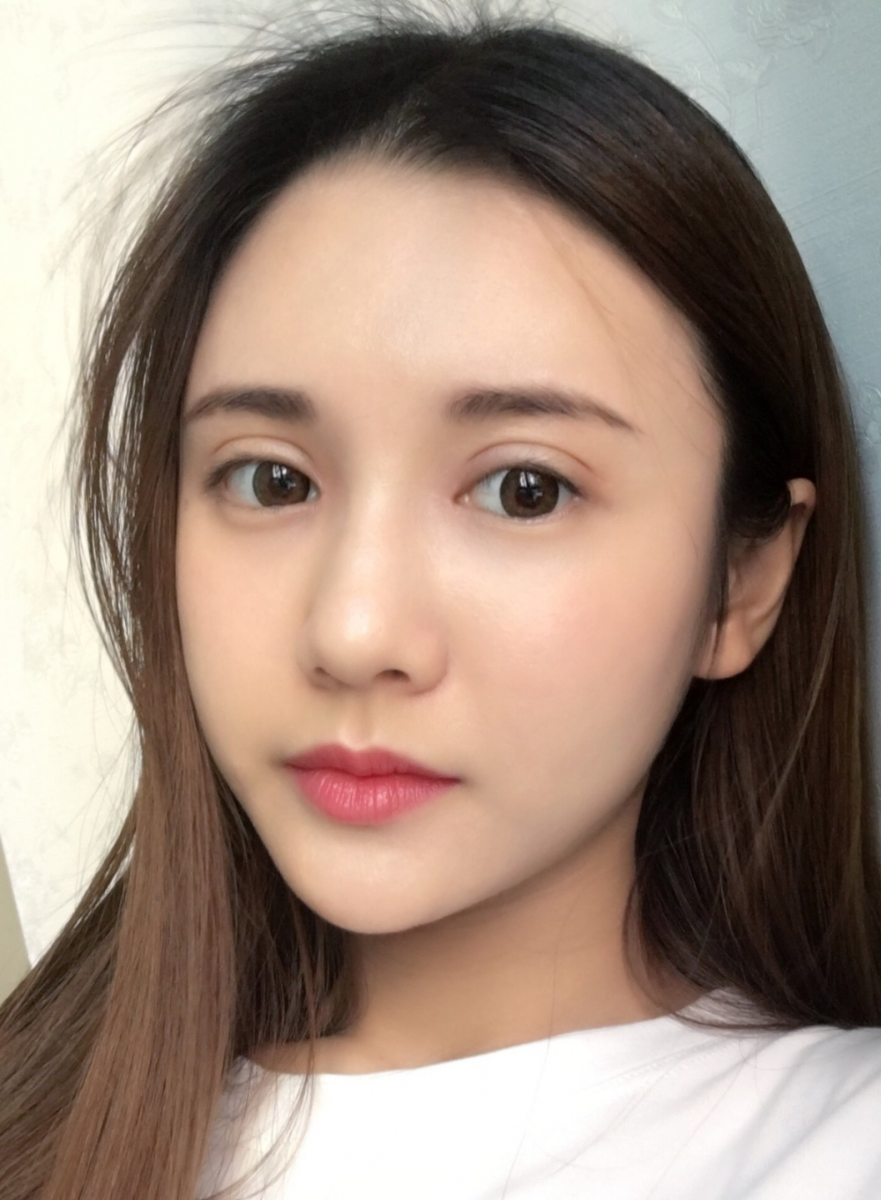 鄭州銘藝整形醫(yī)生陳濤做切開雙眼皮怎么樣？鄭州銘藝切開雙眼皮案例