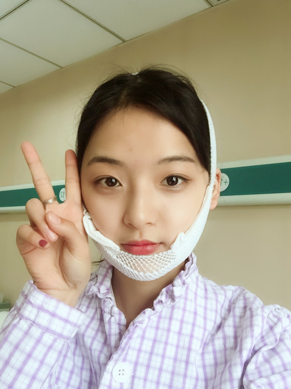 鄭州名門整形醫(yī)院董斌醫(yī)生做下頜角整形怎么樣？附下頜角整形案例