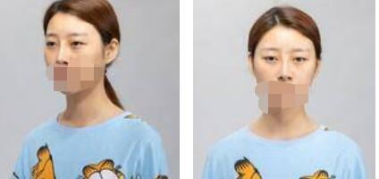 太原歐美蓮整形醫(yī)院丁曉峰醫(yī)生做雙眼皮怎么樣？丁曉峰雙眼皮手術案例分享