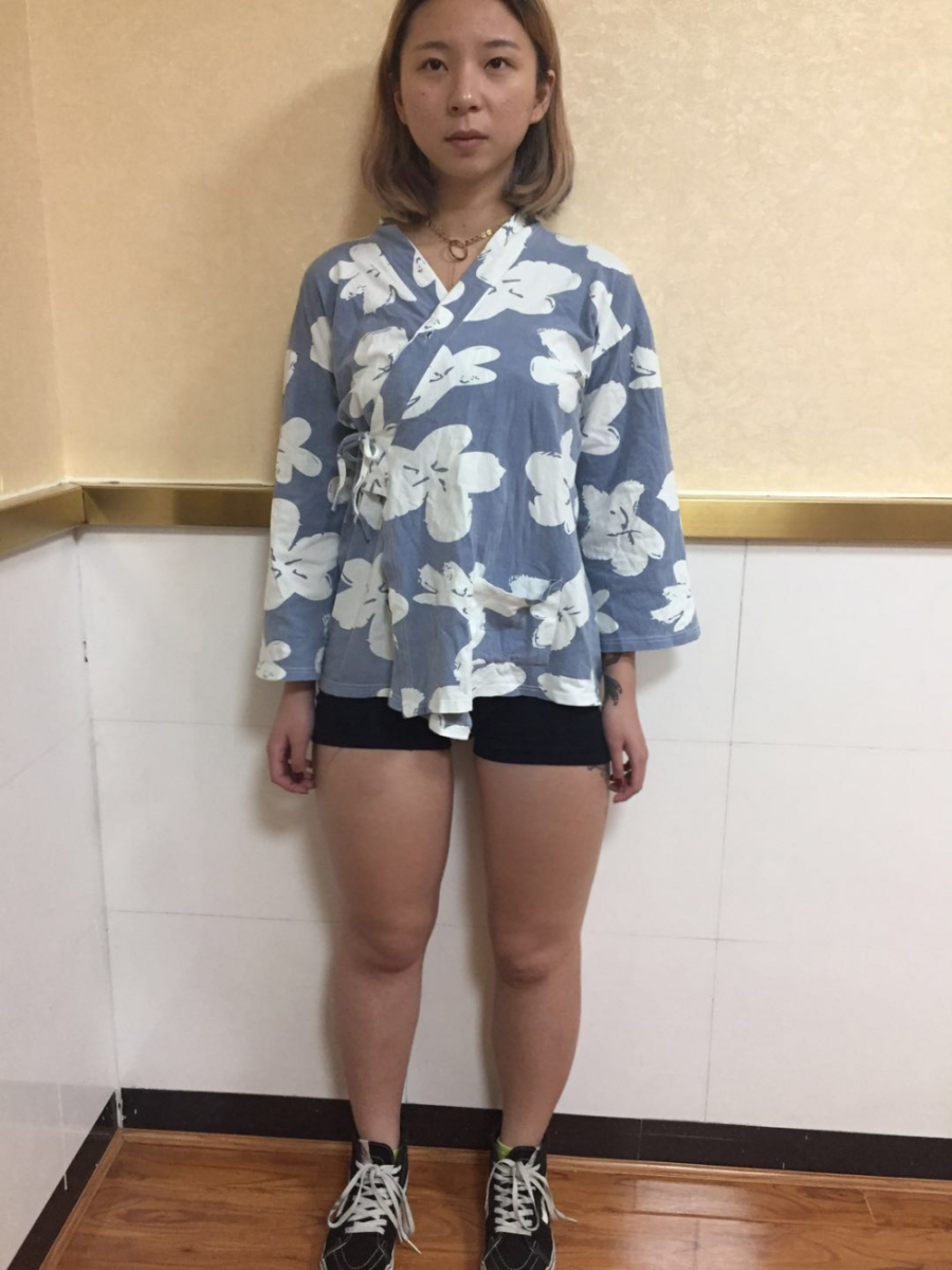 深圳鵬愛醫(yī)療整形醫(yī)生張建文做大腿吸脂怎么樣？附大腿吸脂案例效果對比圖