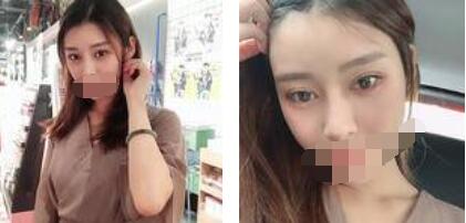 太原歐美蓮整形醫(yī)院丁曉峰醫(yī)生做雙眼皮怎么樣？丁曉峰雙眼皮手術案例分享