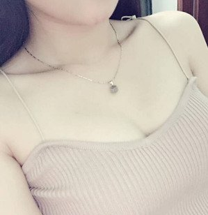 珠海萊茵醫(yī)療美容醫(yī)院崔俊溶醫(yī)生做自體脂肪隆胸效果怎么樣？附自體脂肪隆胸案例