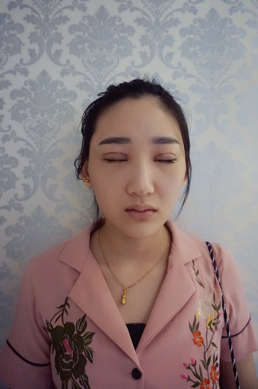 武漢中翰整形外科醫(yī)院沈磊醫(yī)生做切開雙眼皮怎么樣？附沈磊切開雙眼皮案例