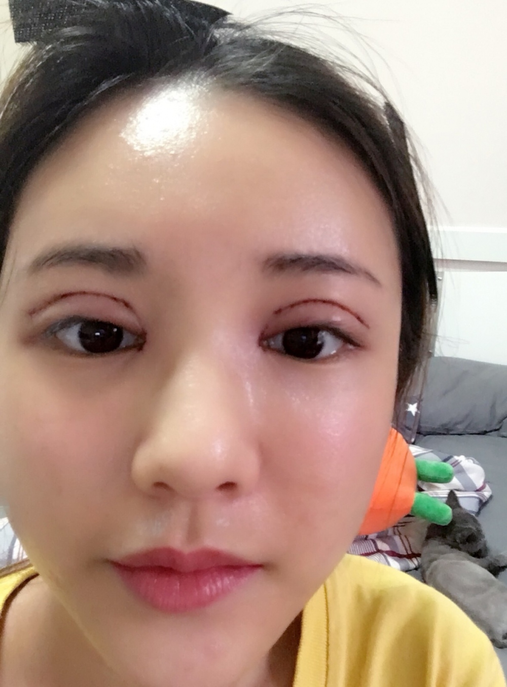 鄭州銘藝整形醫(yī)生陳濤做切開雙眼皮怎么樣？鄭州銘藝切開雙眼皮案例
