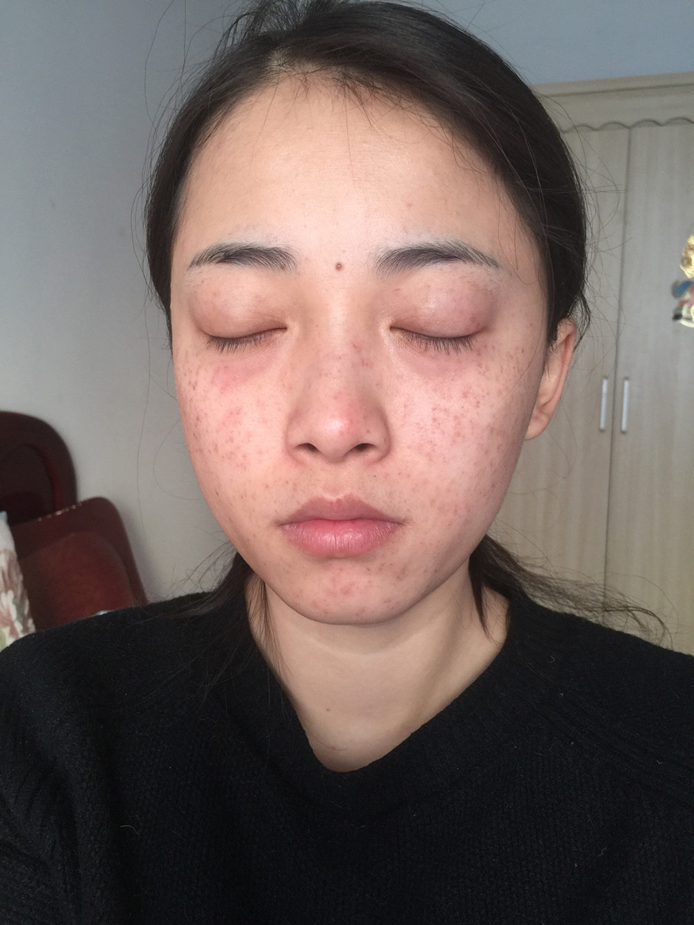 重慶當(dāng)代整形李敏旭醫(yī)生做皮秒激光祛斑效果怎么樣？附皮秒激光祛斑案例