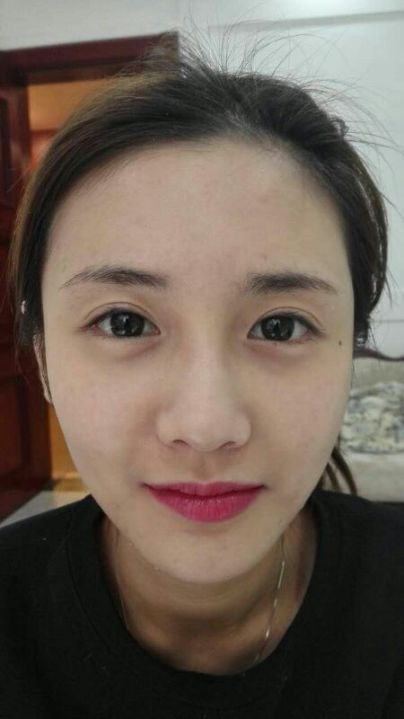 鄭州銘藝整形醫(yī)生陳濤做切開雙眼皮怎么樣？鄭州銘藝切開雙眼皮案例