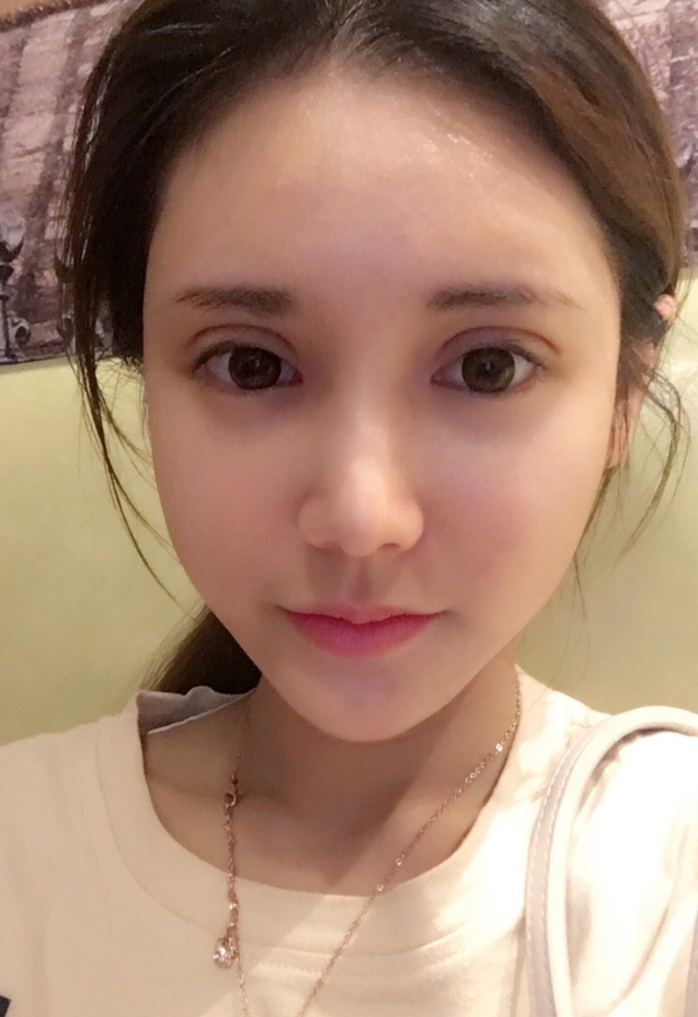 鄭州銘藝整形醫(yī)生陳濤做切開雙眼皮怎么樣？鄭州銘藝切開雙眼皮案例