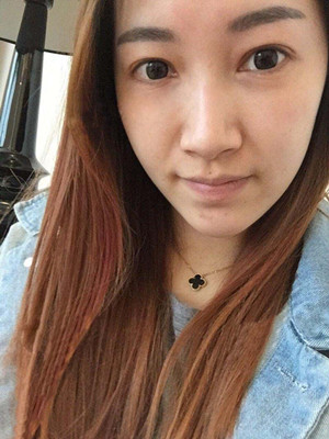 重慶五洲女子醫(yī)院整形美容中心做光子嫩膚怎么樣？淡明斌醫(yī)生光子嫩膚案例