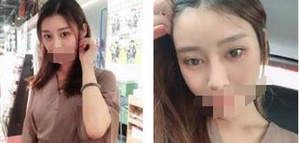 太原歐美蓮整形醫(yī)院丁曉峰醫(yī)生做雙眼皮怎么樣？丁曉峰雙眼皮手術案例分享