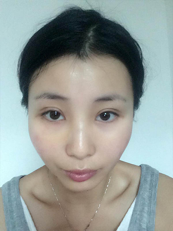 桂林新華醫(yī)療美容醫(yī)生李新華做雙眼皮手術(shù)怎么樣？李新華雙眼皮手術(shù)案例