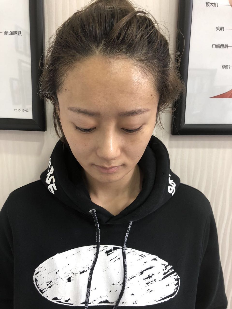 杭州迪美整形常德成醫(yī)生做鼻綜合整形技術(shù)怎么樣？附鼻綜合整形案例