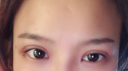 長春麥西美嘉整形醫(yī)生王圣博做雙眼皮手術(shù)效果怎么樣？附雙眼皮案例