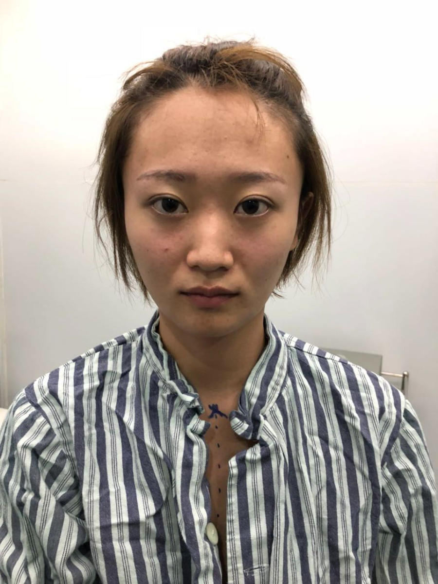杭州迪美整形常德成醫(yī)生做鼻綜合整形技術(shù)怎么樣？附鼻綜合整形案例