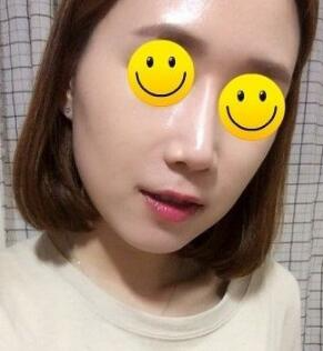 信陽東方藝美容醫(yī)院劉力萌做玻尿酸去法令紋效果怎么樣？附案例效果對比圖