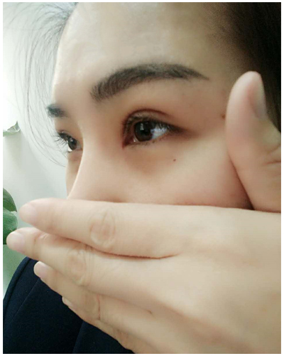 營口臻美醫(yī)療整形醫(yī)生閆迎軍做雙眼皮效果怎么樣？附雙眼皮案例對(duì)比圖