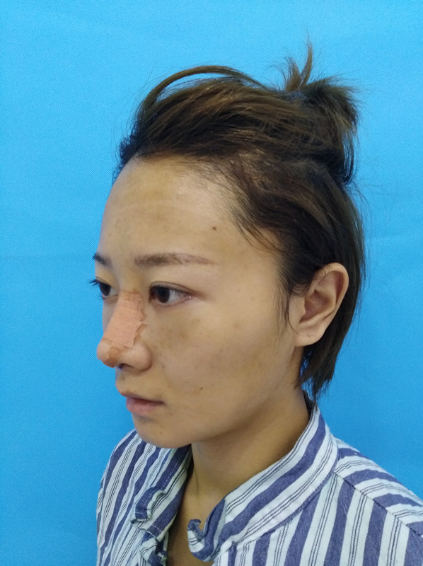 杭州迪美整形常德成醫(yī)生做鼻綜合整形技術(shù)怎么樣？附鼻綜合整形案例
