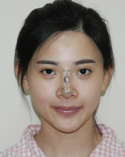 襄陽維多利亞整形醫(yī)院安邰晥醫(yī)生做鼻綜合整形怎么樣？附鼻綜合整形案例
