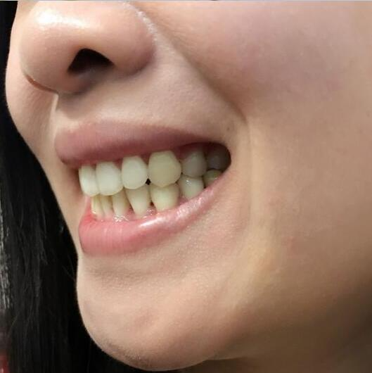 重慶嘉悅口腔醫(yī)院周繼祥醫(yī)生做金屬托槽矯正效果怎么樣？附案例效果對(duì)比圖