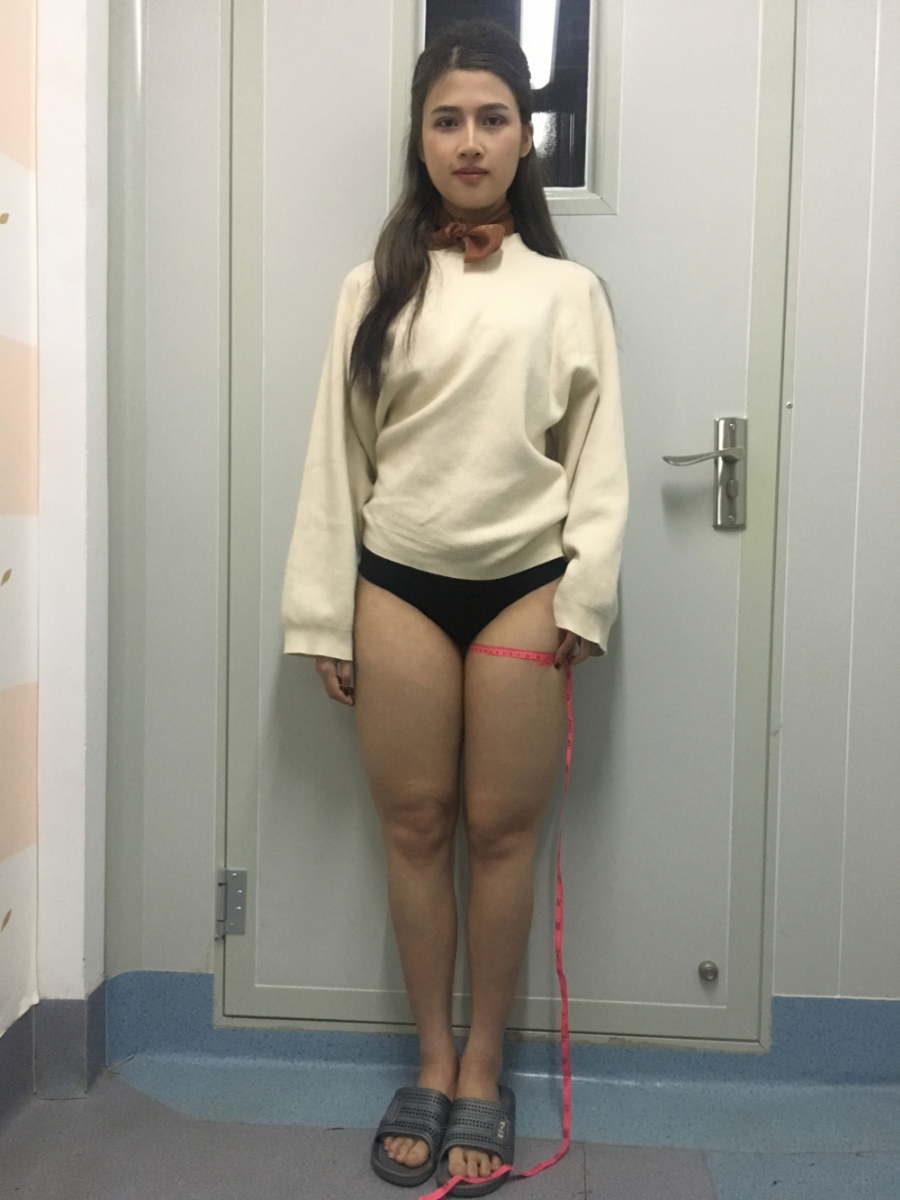 晉城鳳凰整形美容醫(yī)院宋發(fā)興醫(yī)生做大腿吸脂怎么樣？附大腿吸脂案例
