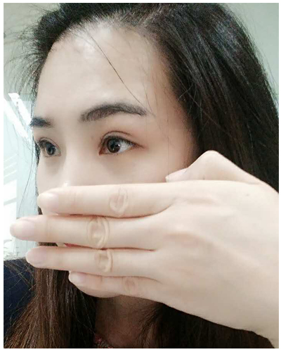 營口臻美醫(yī)療整形醫(yī)生閆迎軍做雙眼皮效果怎么樣？附雙眼皮案例對(duì)比圖