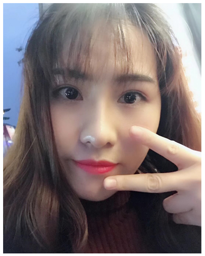營(yíng)口臻美醫(yī)療整形醫(yī)生閆迎軍做雙眼皮效果怎么樣？附雙眼皮案例對(duì)比圖