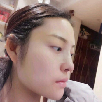 武漢維納斯整形醫(yī)院韓國濤醫(yī)生做鼻綜合整形怎么樣？附鼻綜合整形案例
