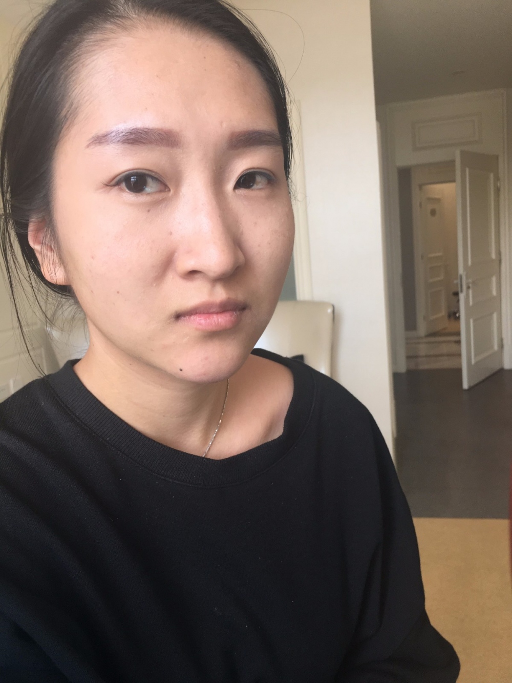 廣州廣大整形美容醫(yī)院任生醫(yī)生做玻尿酸豐面頰+注射瘦臉案例效果對(duì)比圖